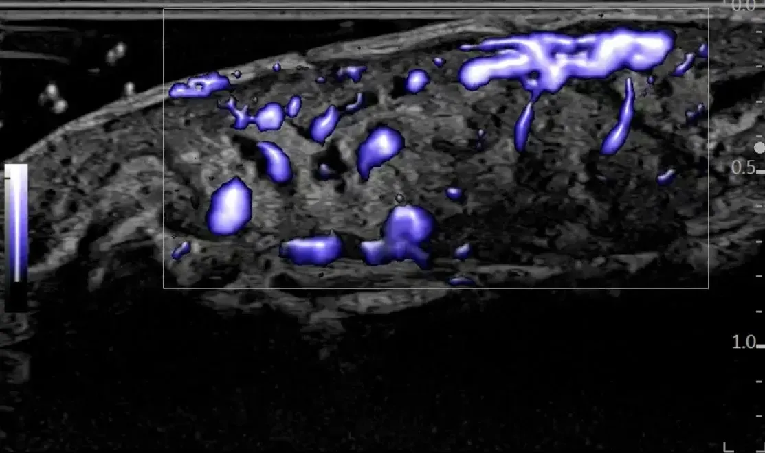 Micro Vascular Imaging and Radiantflow™ with high frequency hockey stick probe