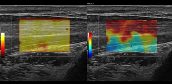 2D SWE in a superficial tendon