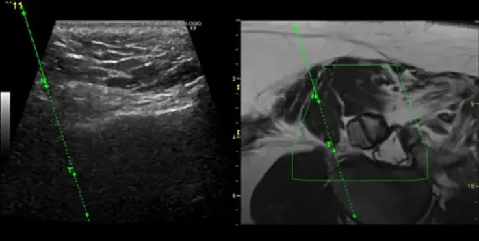 Fusion Imaging US MRI in a spine procedure