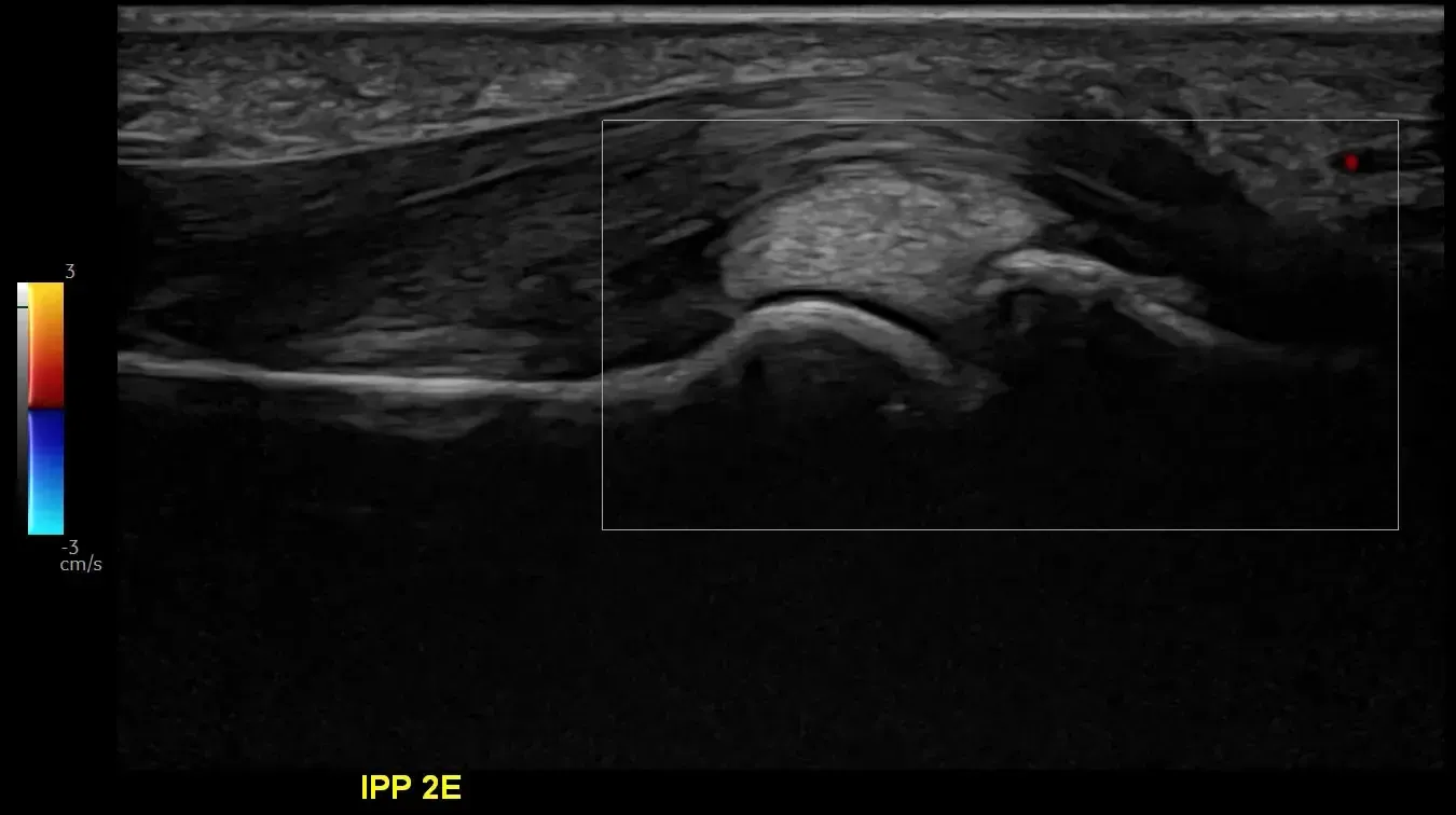 Finger’s tendon with high frequency hockey stick probe