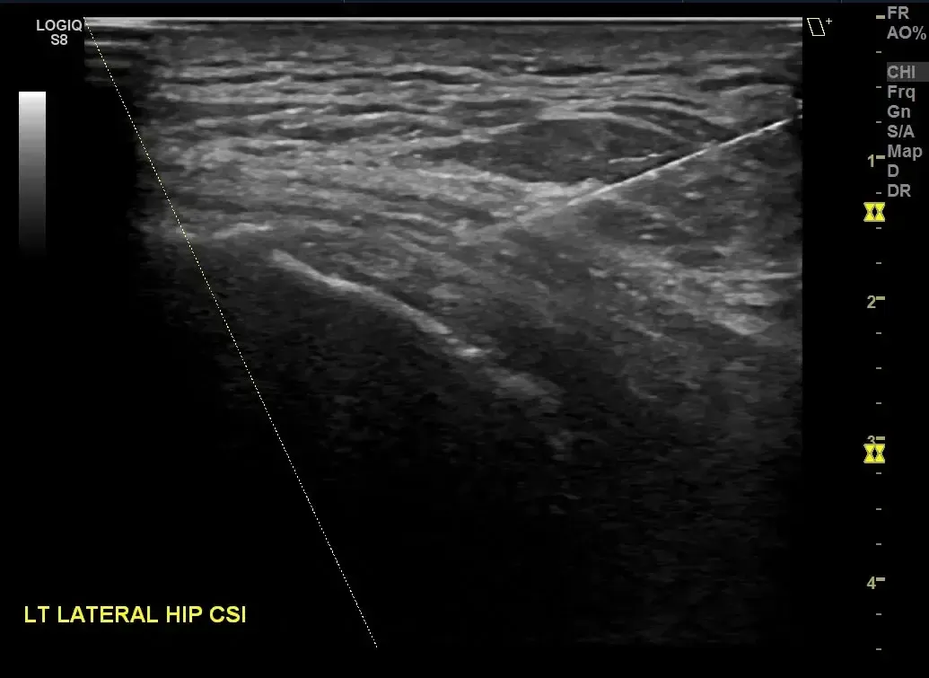 B-Steer+ needle visualization for hip injection