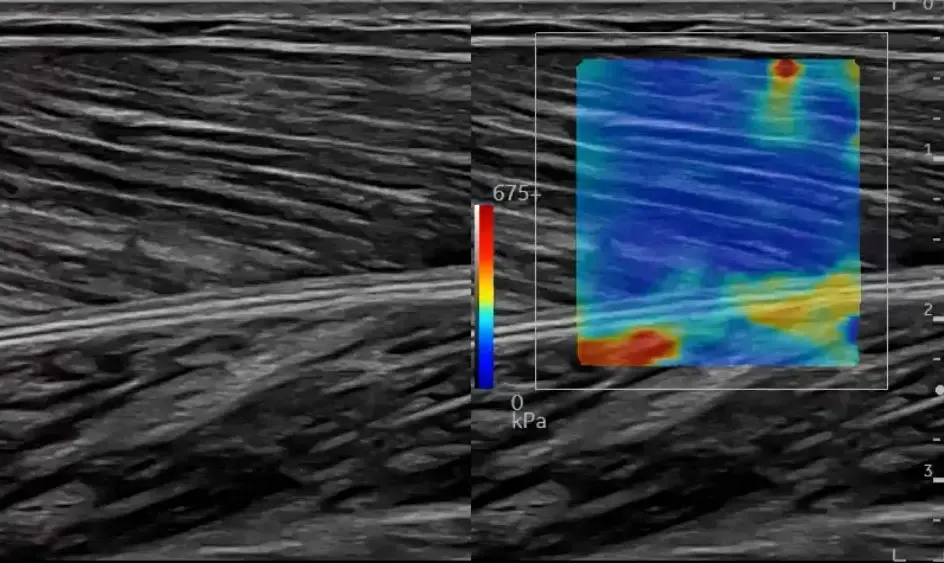 2D SWE in a muscle