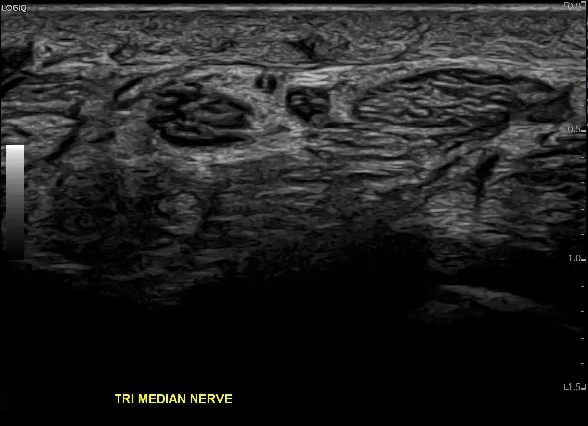 Median nerve with high frequency hockey stick probe