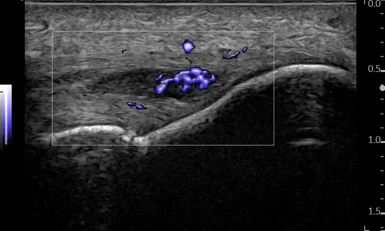 Micro Vascular Imaging and Radiantflow™