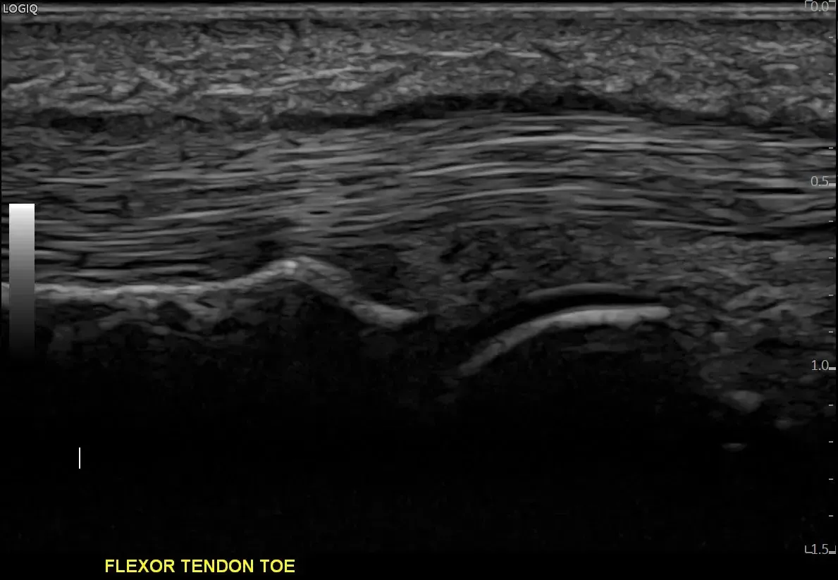 Flexor tendon with high frequency hockey stick probe