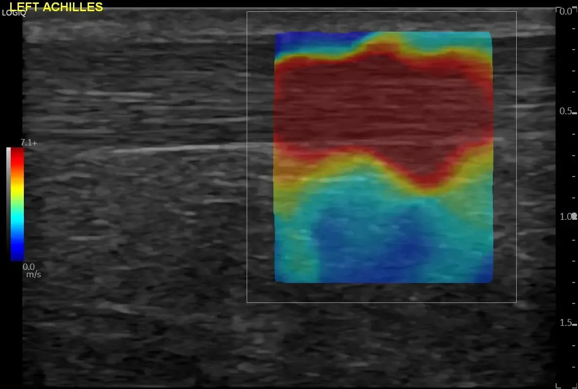 2D SWE in Achilles tendon study