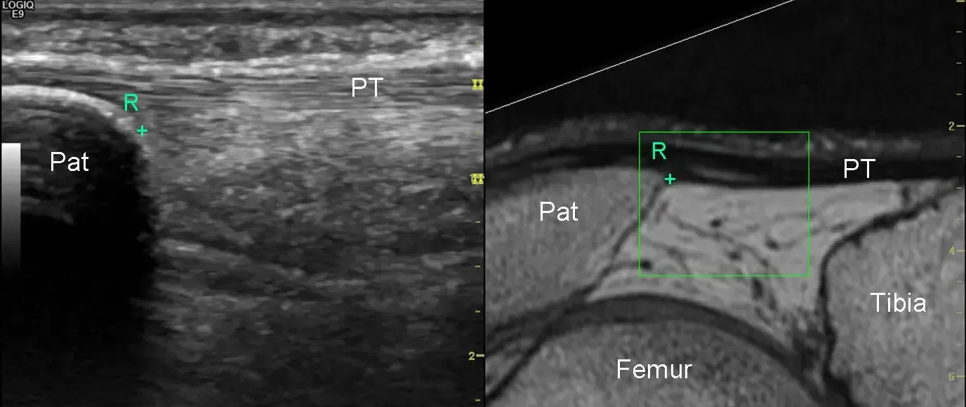 Fusion Imaging hip joint