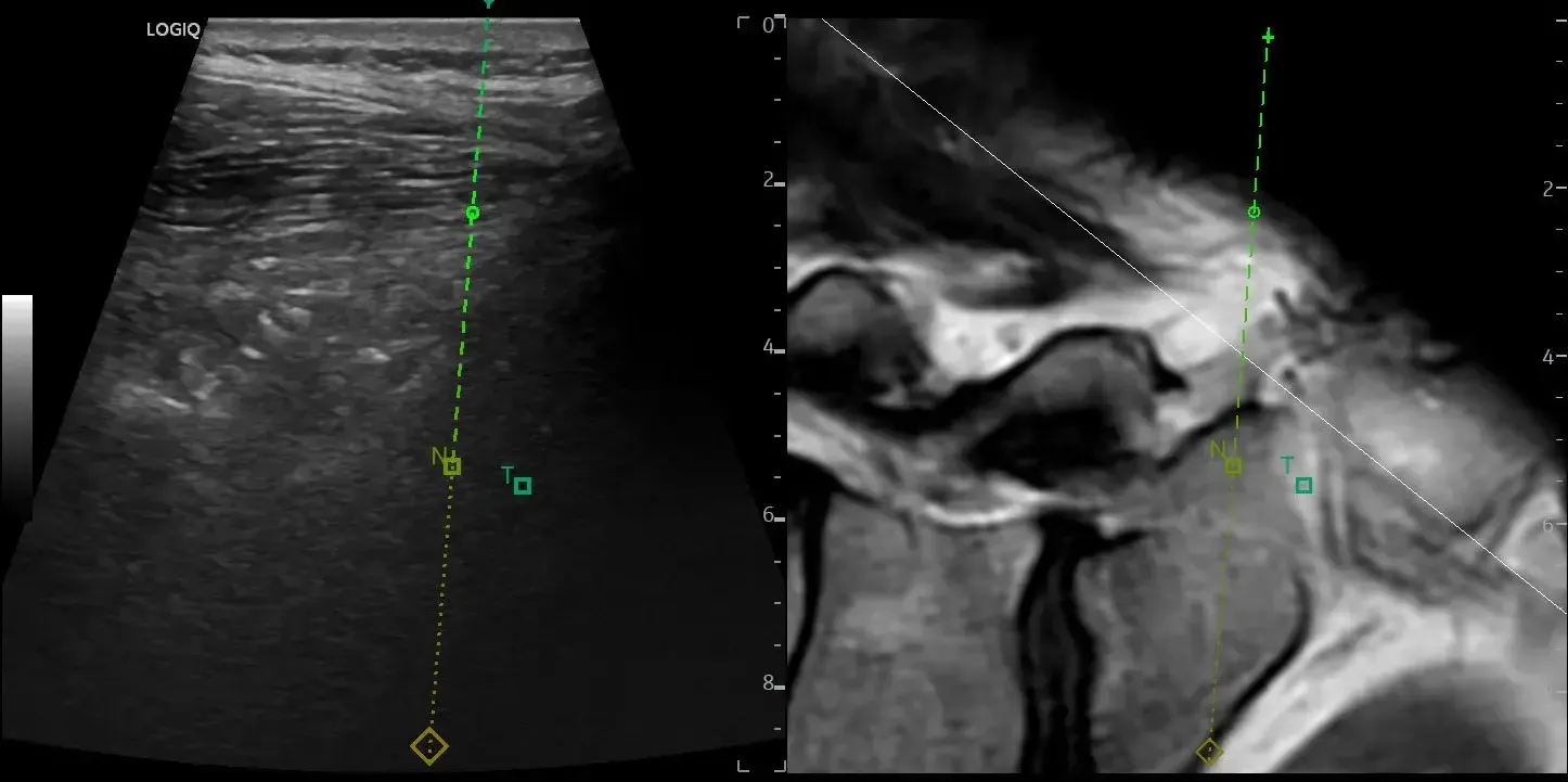 Needle Tip Tracker and Fusion Imaging in an interventional procedure