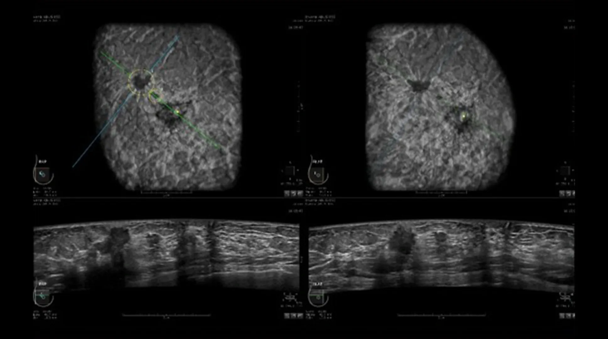 Multi-planar view in ABUS