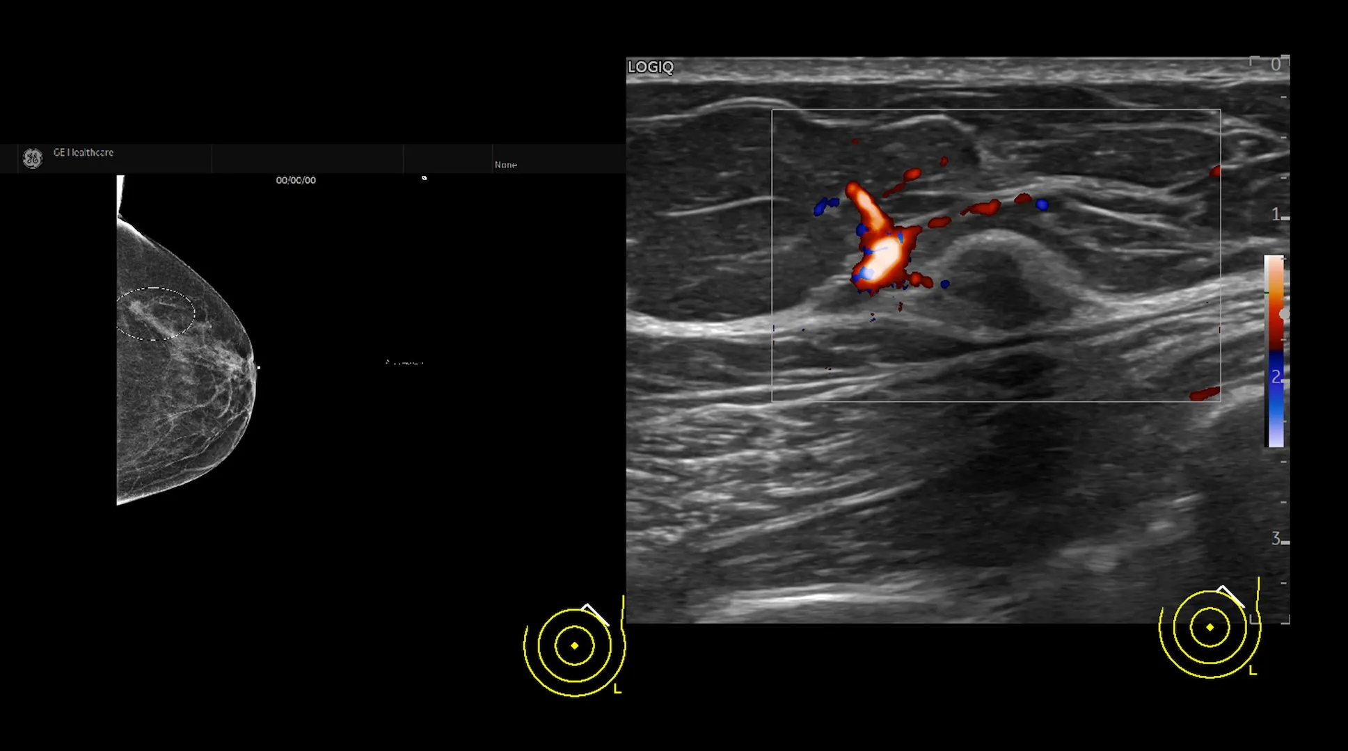 Multi-modality Imaging with Mammo and Ultrasound in MVI Mode