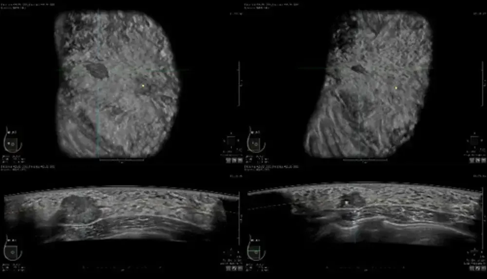 ABUS Auto prior compare under neoadjuvant chemotherapy monitoring