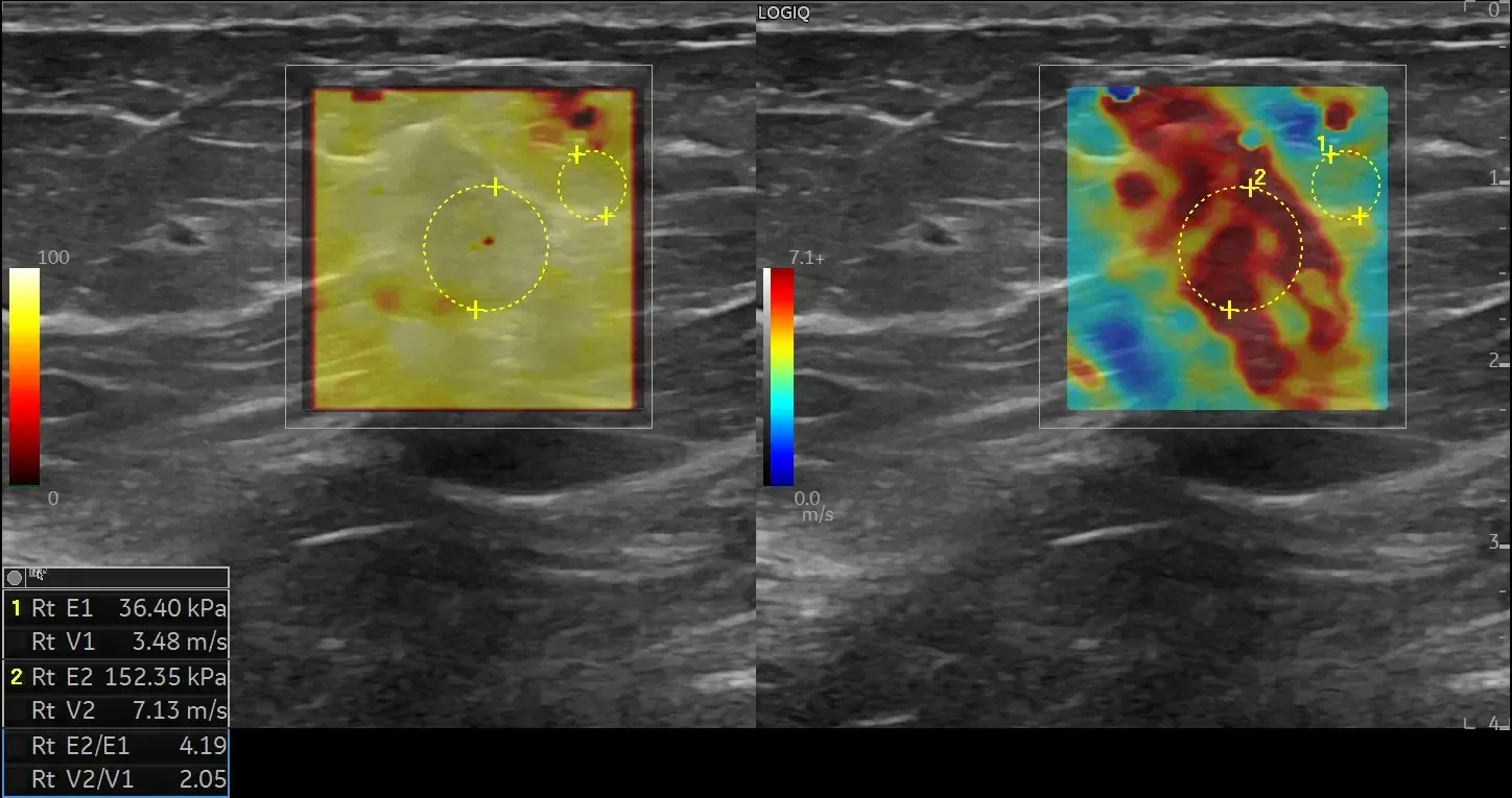 2D SWE with Quality Map for the study of a breast lesion stiffness