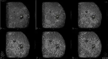 ABUS Multi Slice - Mammography occult IDC