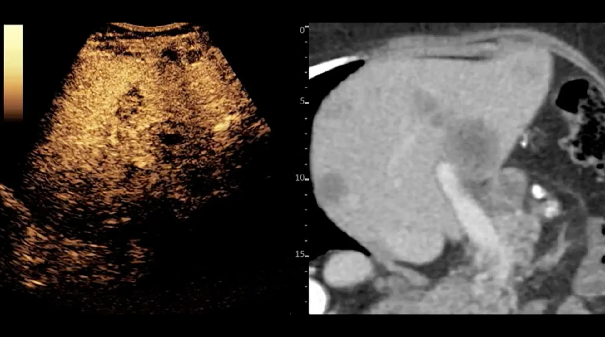 Liver lesions study with Fusion Imaging and CEUS