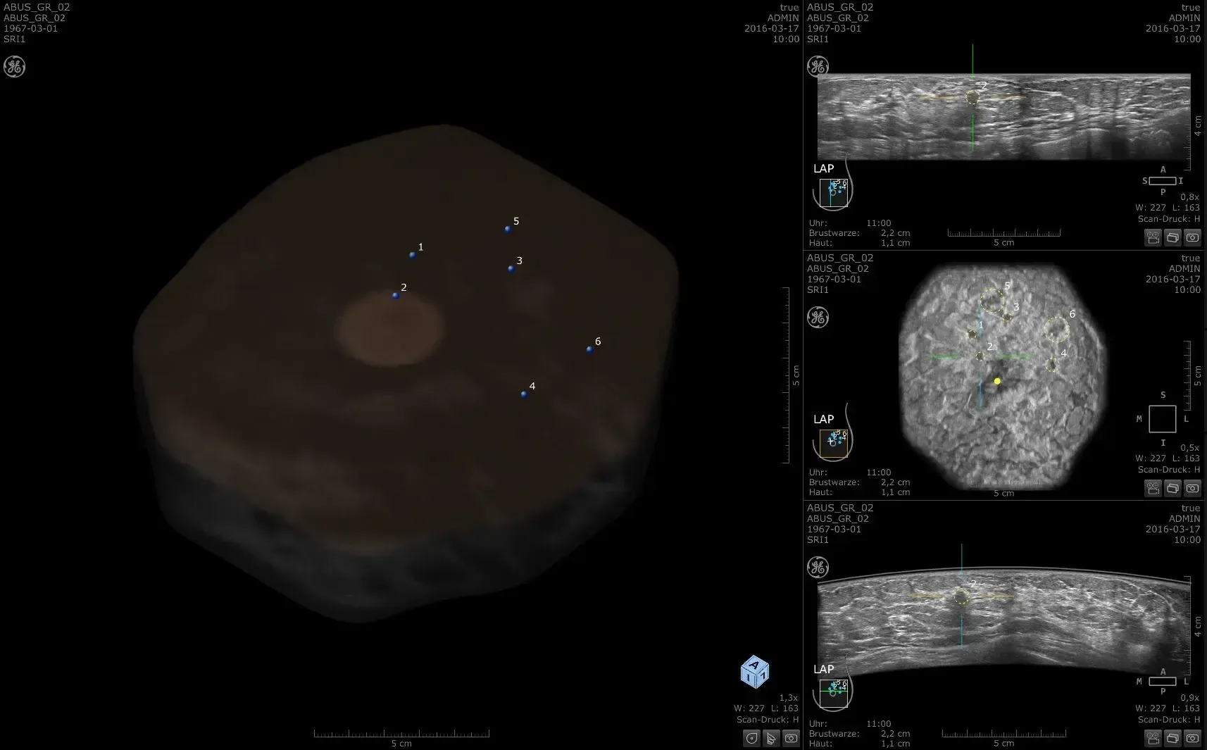 Treatment planning multi-centric and multi-focal IDC