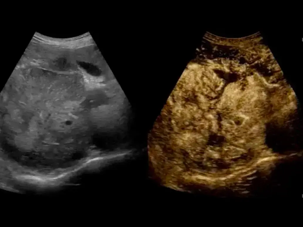 Contrast enhanced ultrasound 2