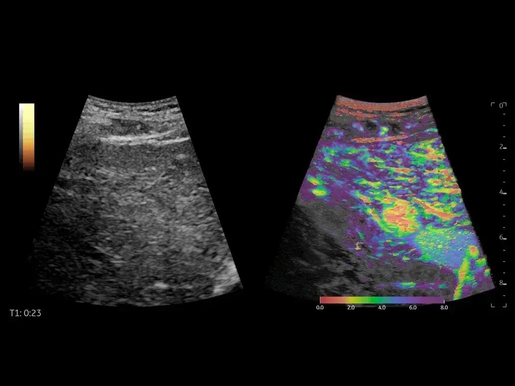 Contrast enhanced ultrasound