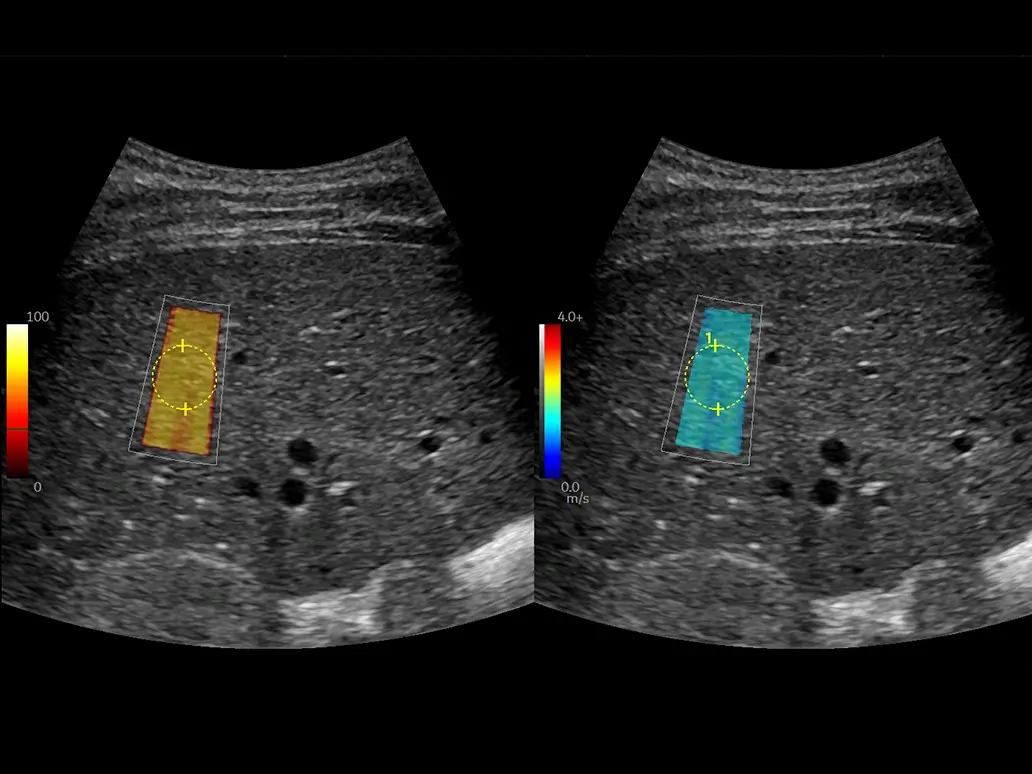 Fibrosis staging with 2d swe