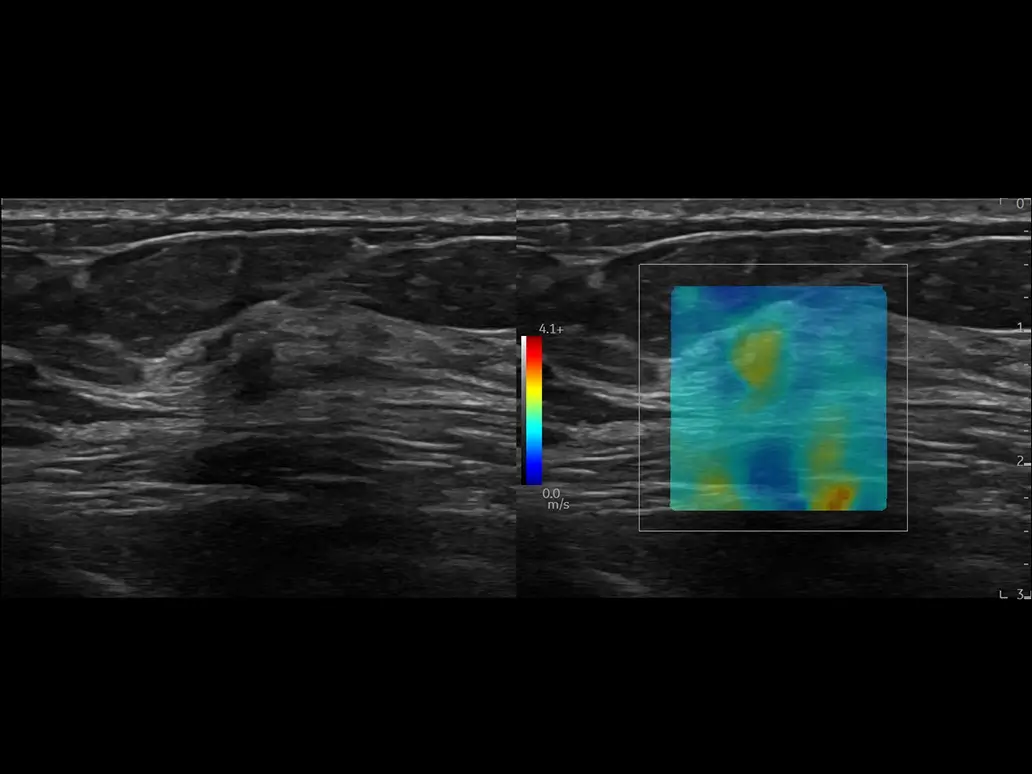 Lesion assessment with 2d swe breast