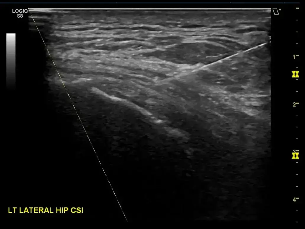 Msk enhanced needle visualization with b steer+