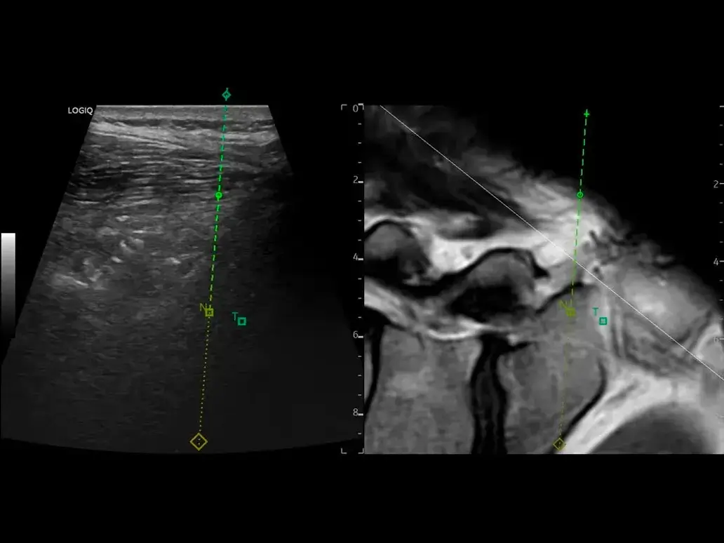 Msk increase biopsy confidence withneedle tip tracking