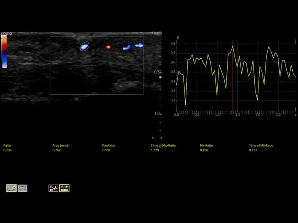 Msk inflammation stagign with flow quantification