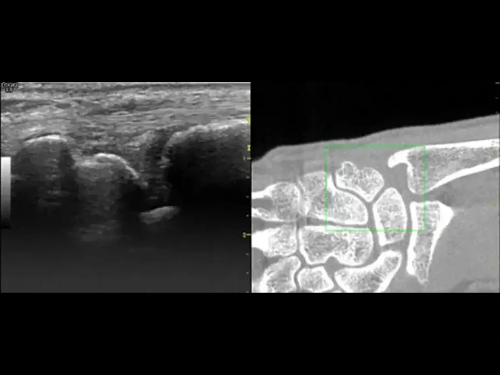 Msk precise guidance withfusion imaging